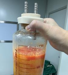 沛县水动力吸脂手术要做多久？